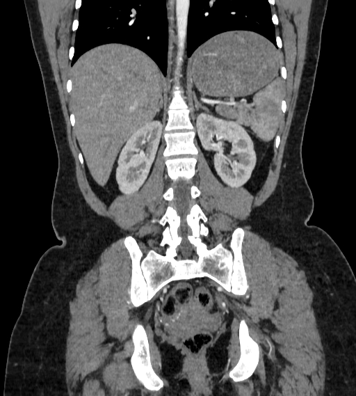 Bilateral ovarian mature cystic teratomas (Radiopaedia 79373-92457 B 64).jpg