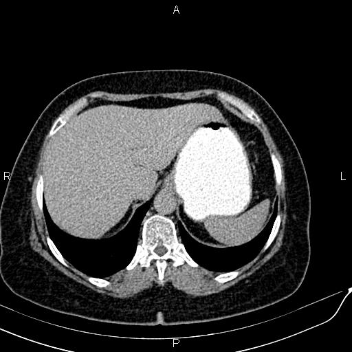 Bilateral ovarian serous cystadenocarcinoma (Radiopaedia 86062-101989 Axial C+ delayed 4).jpg
