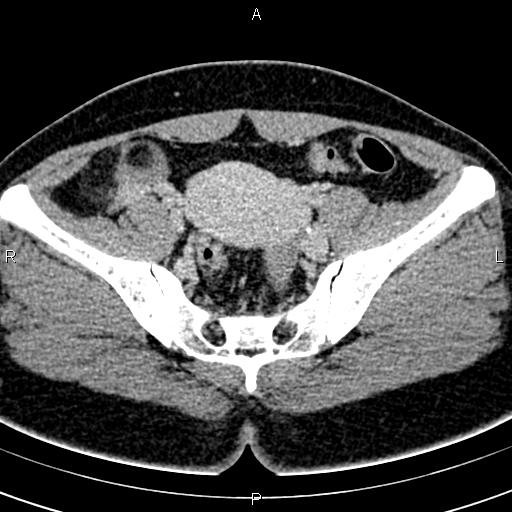 Bilateral ovarian teratoma (Radiopaedia 83131-97503 B 32).jpg