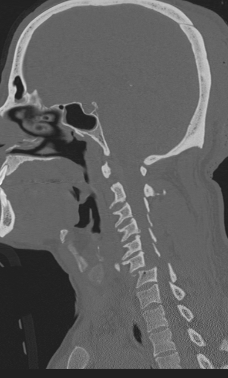 Bilateral perched facet joint (Radiopaedia 63149-71669 Sagittal bone window 20).jpg