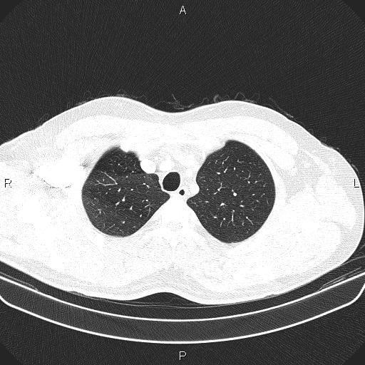 File:Bilateral pulmonary AVM (Radiopaedia 83134-97505 Axial lung window 14).jpg