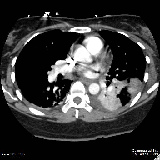 Bilateral pulmonary emboli with Hampton hump sign (Radiopaedia 54070-60246 Axial C+ CTPA 36).jpg