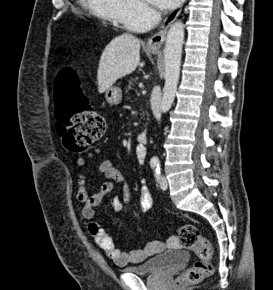 File:Bilateral rectus sheath hematomas (Radiopaedia 50778-56252 B 43).jpg