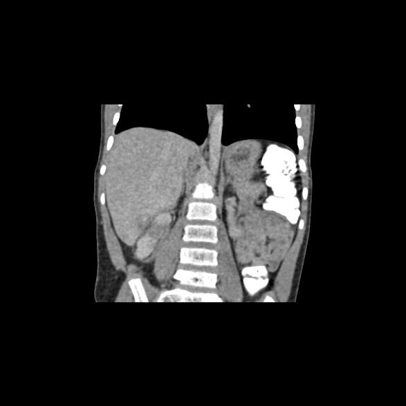 File:Bilateral renal malrotation (Radiopaedia 30901-31606 B 3).jpg