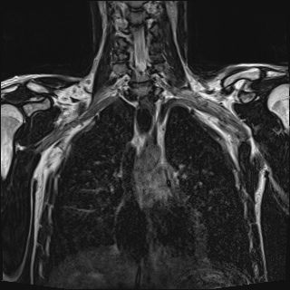Bilateral spinoglenoid notch ganglion cysts (Radiopaedia 29577-30082 Coronal T2 55).jpg