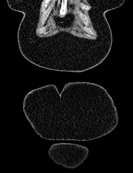 Bilateral staghorn calculi (Radiopaedia 59475-66842 Coronal non-contrast 29).jpg