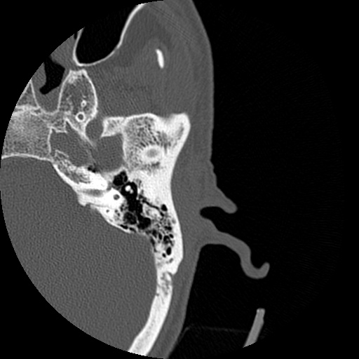 Bilateral temporal bone fractures (Radiopaedia 29482-29970 D 86).jpg