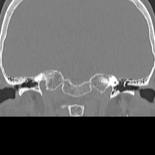 File:Bilateral tympanoplasty (Radiopaedia 16947-16664 Coronal bone window 7).jpg