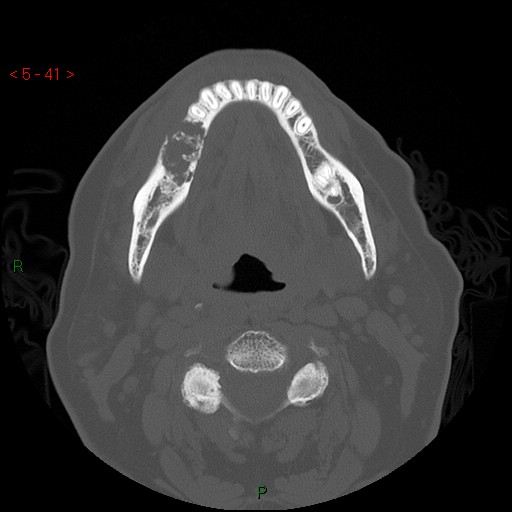 Bisphosphonate-related osteonecrosis of the jaw (Radiopaedia 54147-60329 Axial bone window 35).jpg