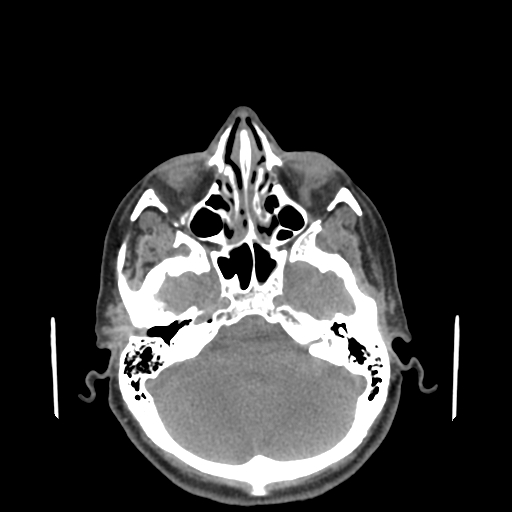 File:Bisphosphonate-related osteonecrosis of the jaw (Radiopaedia 71324-81642 non-contrast 166).jpg