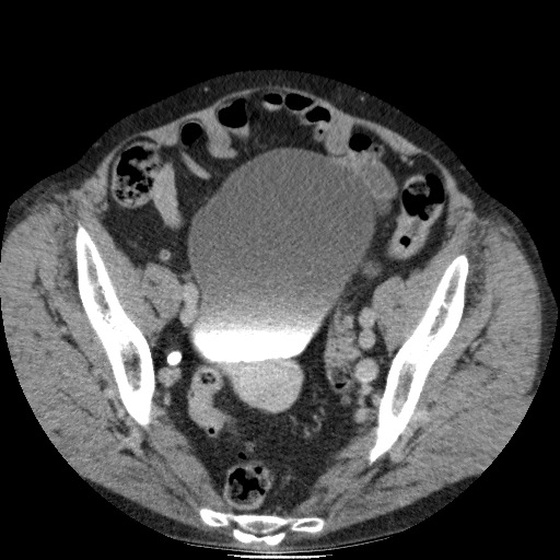 Bladder tumor detected on trauma CT (Radiopaedia 51809-57609 C 112).jpg
