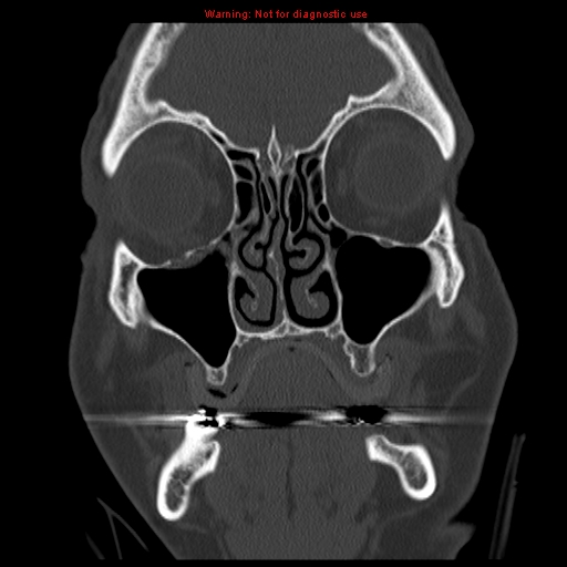 File:Blowout fracture with inferior rectus entrapment (Radiopaedia 12418-12673 Coronal bone window 4).jpg
