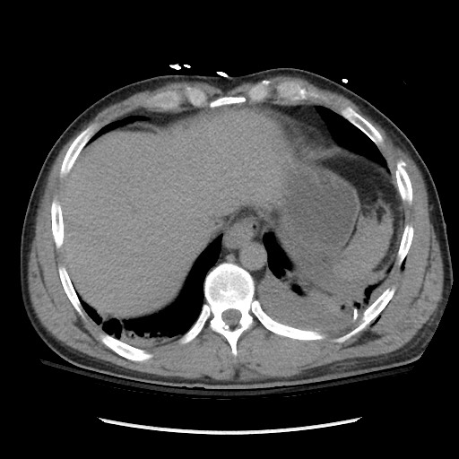 Blunt abdominal trauma with solid organ and musculoskelatal injury with active extravasation (Radiopaedia 68364-77895 Axial C+ delayed 21).jpg