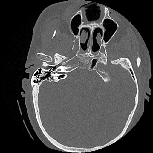 File:Blunt cerebrovascular injury (Radiopaedia 53682-59743 Axial bone window 4).png