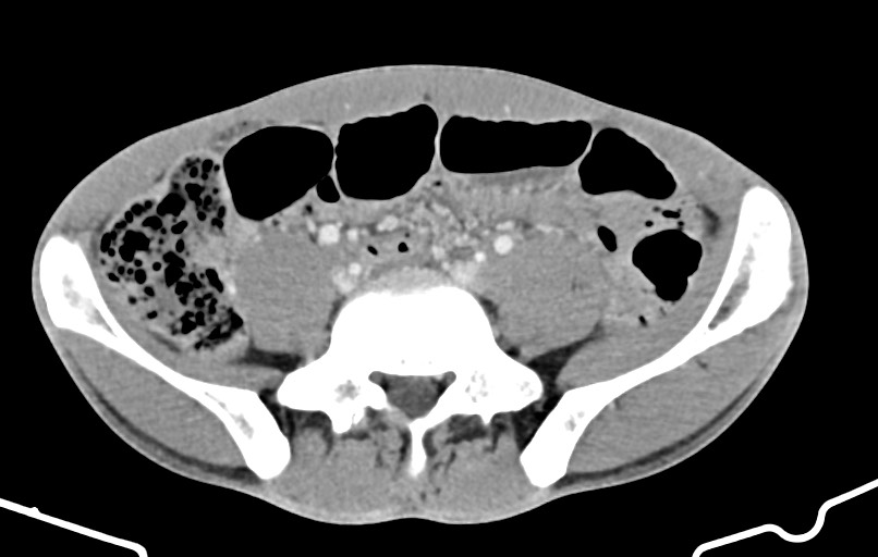 Blunt injury to the small bowel (Radiopaedia 74953-85987 A 131).jpg