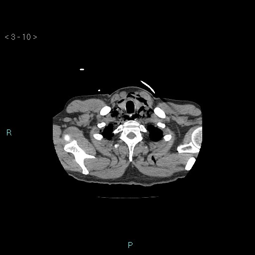 Boerhaave syndrome (Radiopaedia 27683-27897 Axial non-contrast 10).jpg