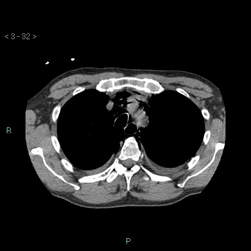 Boerhaave syndrome (Radiopaedia 27683-27897 oral contrast 32).jpg