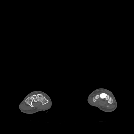 Bone islands - carpus (Radiopaedia 63141-71658 Axial bone window 38).jpg