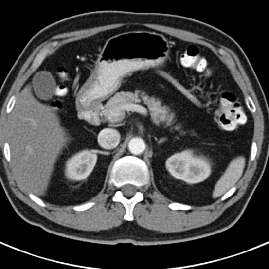 File:Bosniak cyst - type IV (Radiopaedia 23525-23627 renal cortical phase 11).jpg