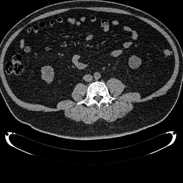 Bosniak renal cyst - type IV (Radiopaedia 24244-24518 Axial non-contrast 198).jpg