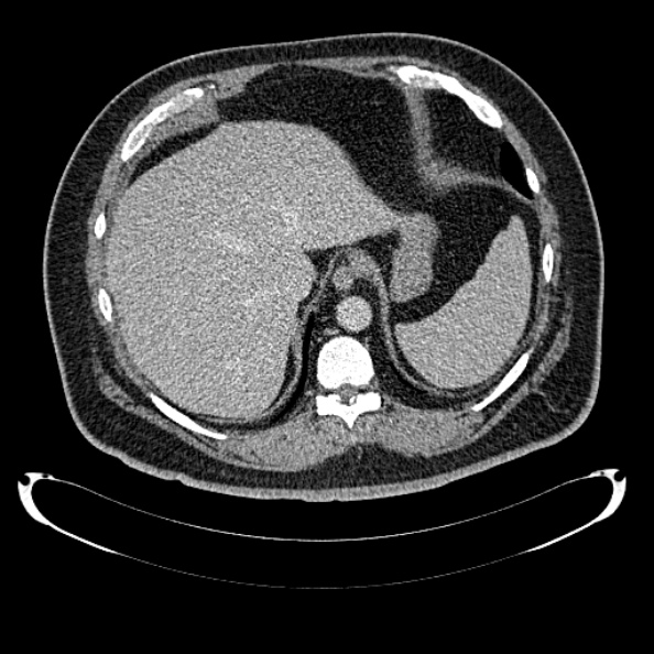 Bosniak renal cyst - type IV (Radiopaedia 24244-24518 C 40).jpg