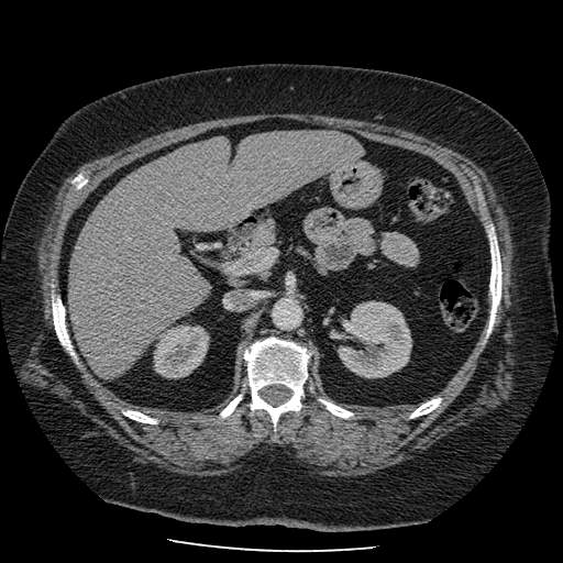 Bovine aortic arch - right internal mammary vein drains into the superior vena cava (Radiopaedia 63296-71875 A 200).jpg