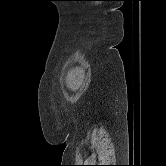 Bowel and splenic infarcts in acute lymphocytic leukemia (Radiopaedia 61055-68913 C 70).jpg