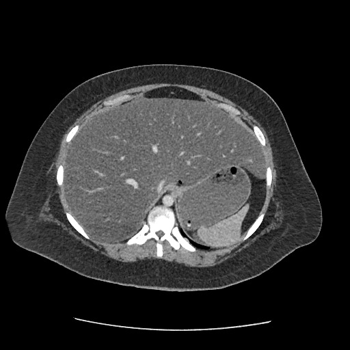 Bowel and splenic infarcts in acute lymphocytic leukemia (Radiopaedia 61055-68915 A 31).jpg