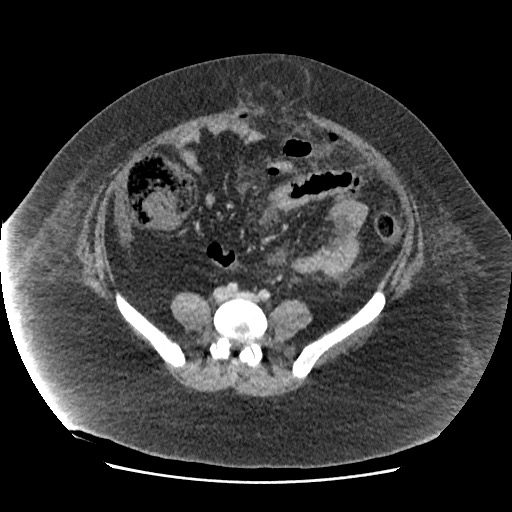 File:Bowel and splenic infarcts in acute lymphocytic leukemia (Radiopaedia 61055-68915 A 89).jpg