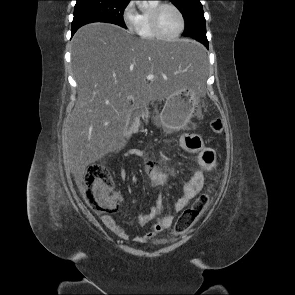 Bowel and splenic infarcts in acute lymphocytic leukemia (Radiopaedia 61055-68915 B 24).jpg