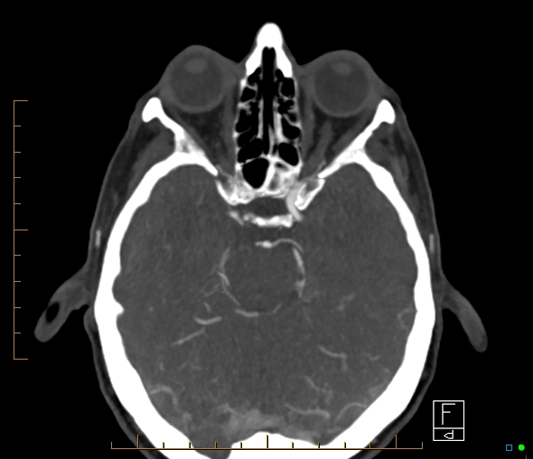 Brachiocephalic trunk stenosis (Radiopaedia 87242-103519 A 45).jpg