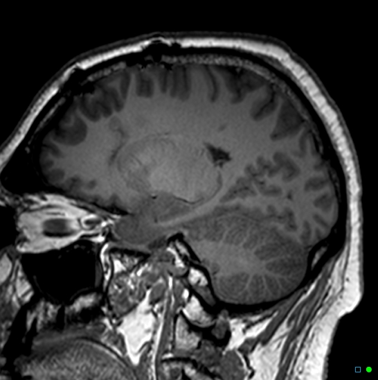 Brain death on MRI and CT angiography (Radiopaedia 42560-45689 Sagittal T1 44).jpg