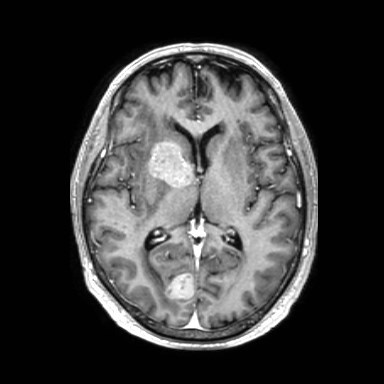 Brain metastases from lung cancer (Radiopaedia 83839-99028 Axial T1 C+ 33).jpg