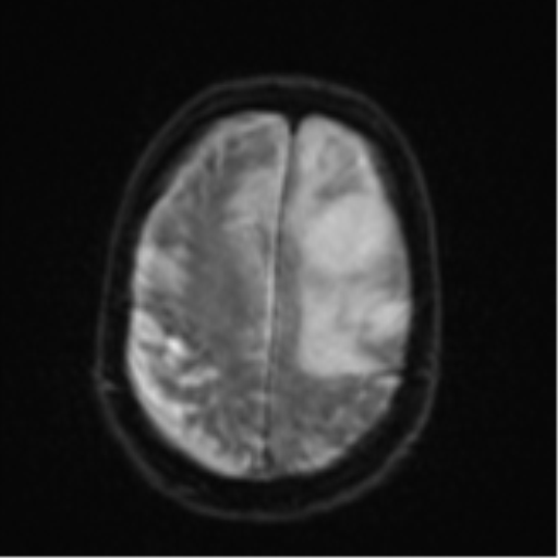 Brain metastasis (lung cancer) (Radiopaedia 48289-53179 Axial DWI 22).png