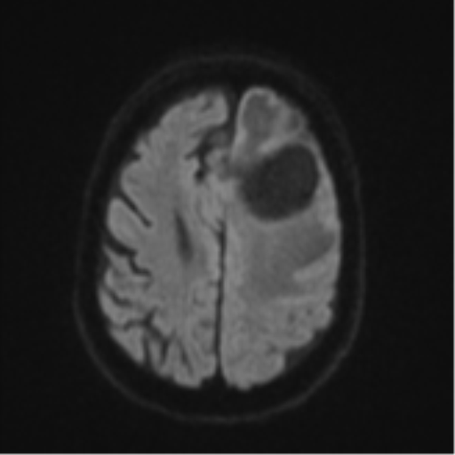 Brain metastasis (lung cancer) (Radiopaedia 48289-53179 Axial DWI 49).png
