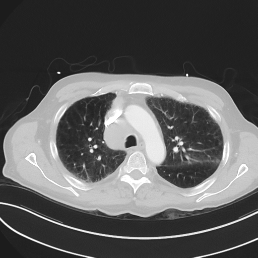 File:Brain metastasis (lung cancer) (Radiopaedia 48289-53180 Axial lung window 20).png