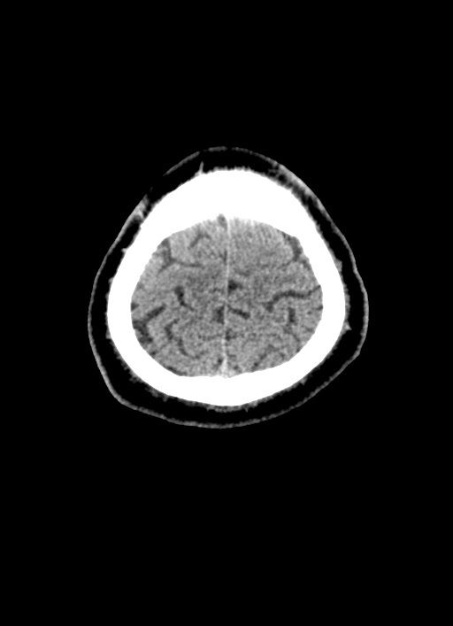 Brainstem hemorrhage (Radiopaedia 81294-94976 Axial non-contrast 10).jpg