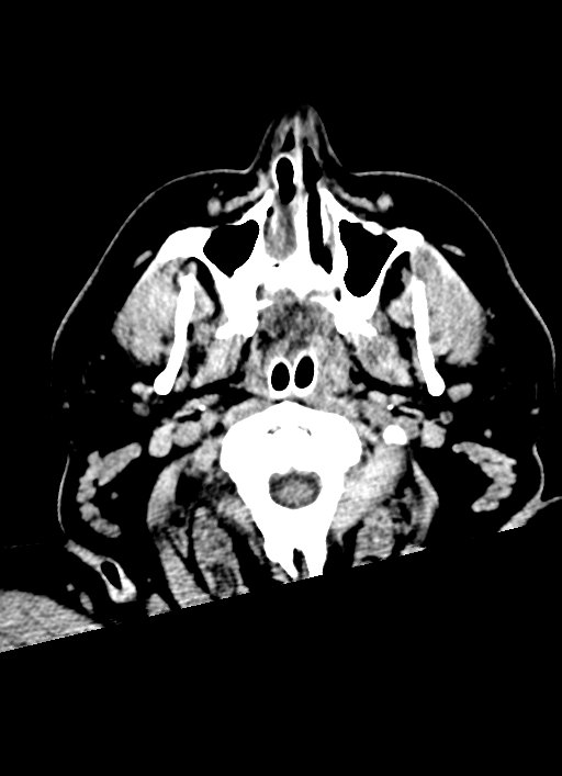 Brainstem hemorrhage (Radiopaedia 81294-94976 Axial non-contrast 66).jpg