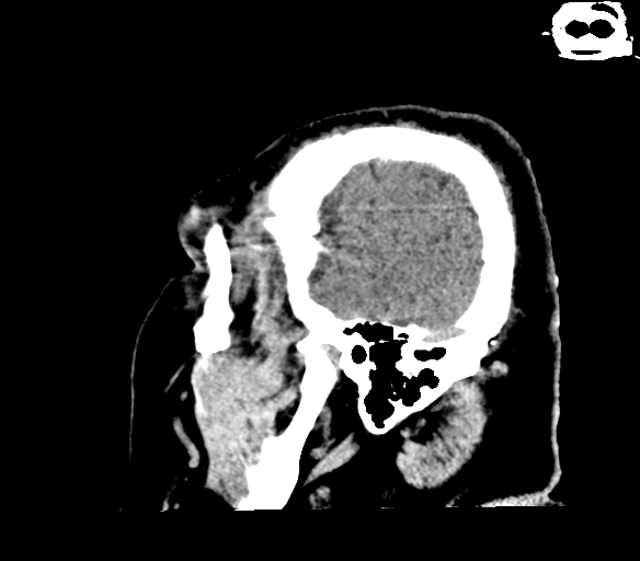 Brainstem hemorrhage (Radiopaedia 81294-94976 C 6).jpg