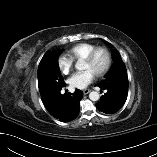 Breast carcinoma with pathological hip fracture (Radiopaedia 60314-67974 A 32).jpg
