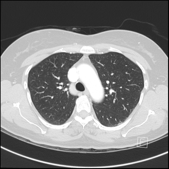 Breast metastases from renal cell cancer (Radiopaedia 79220-92225 Axial lung window 26).jpg