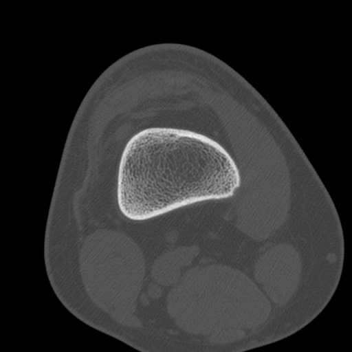 Brodie abscess of the tibia (Radiopaedia 58984-66250 Axial bone window 11).jpg