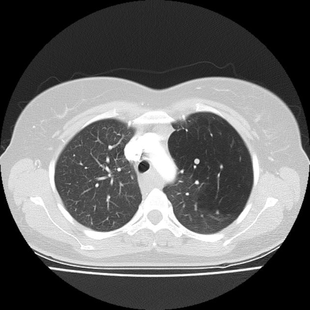 Bronchial atresia (Radiopaedia 22965-22992 Axial lung window 37).jpg