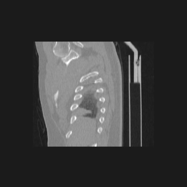 Bronchial atresia (Radiopaedia 60685-68439 Sagittal lung window 3).jpg