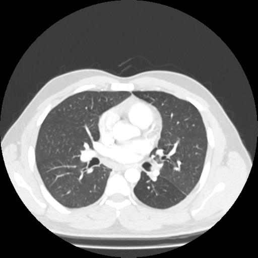 Bronchial carcinoid (Radiopaedia 80013-93291 Axial lung window 58).jpg