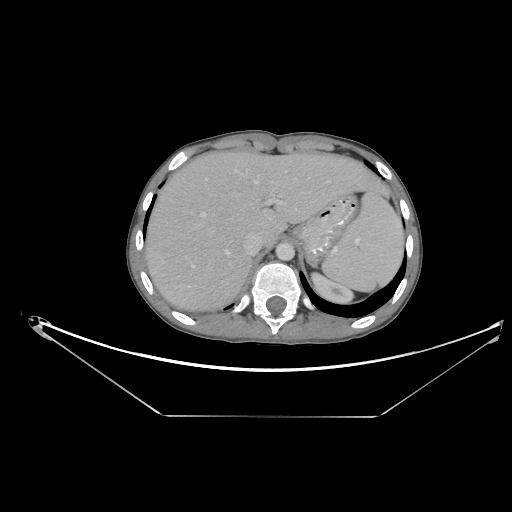 Bronchial carcinoid tumor (Radiopaedia 57187-64090 A 70).jpg
