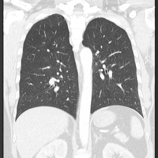 Bronchial carcinoid tumor (Radiopaedia 67377-76764 Coronal lung window 43).jpg