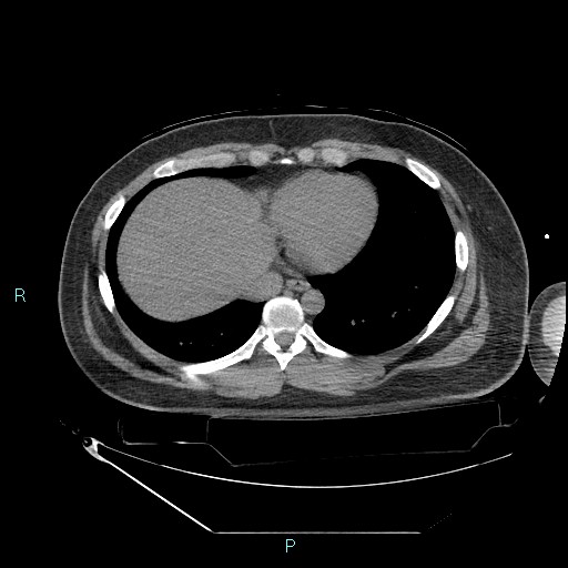 Bronchial carcinoid tumor (Radiopaedia 78272-90870 Axial non-contrast 80).jpg