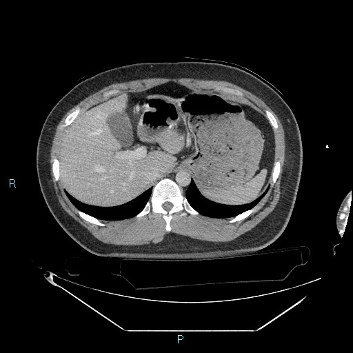 Bronchial carcinoid tumor (Radiopaedia 78272-90870 C 114).jpg