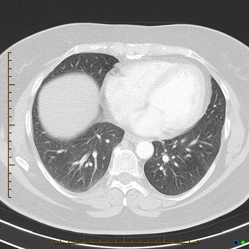 Bronchial diverticula (Radiopaedia 79512-92675 Axial lung window 33).jpg